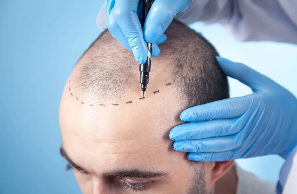 تکنیک‌های مراقبت مو پس از کاشت