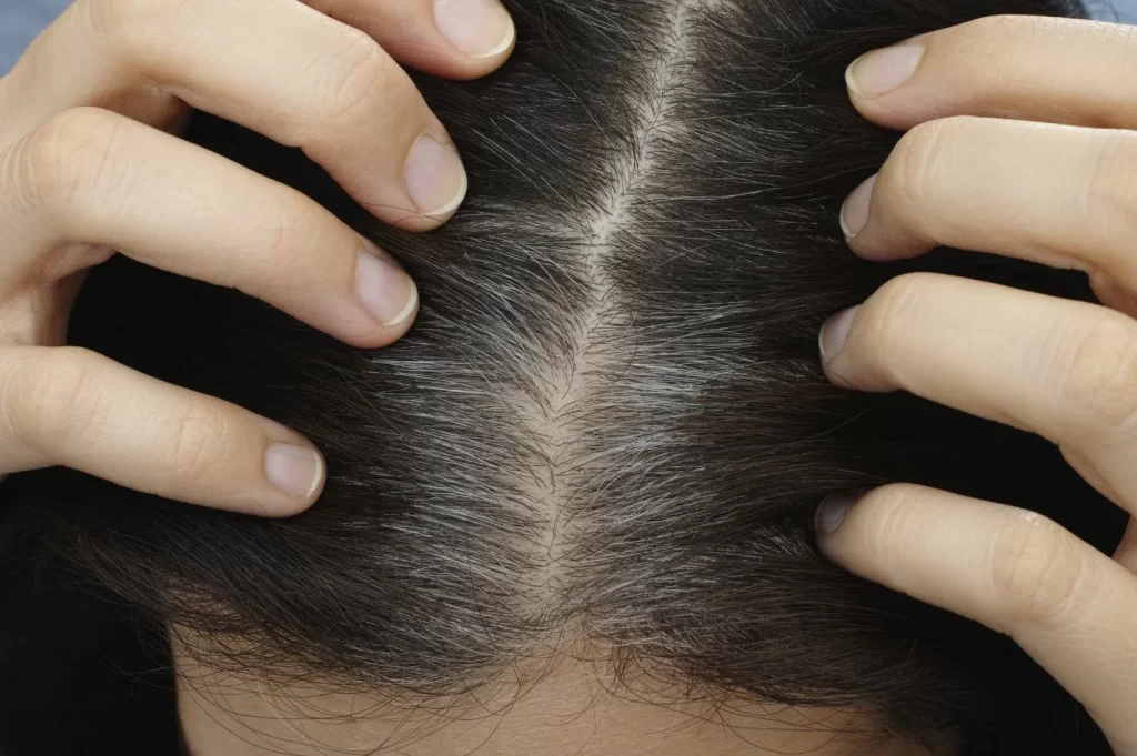 درمان و پیشگیری از سفیدشدن زودرس موها