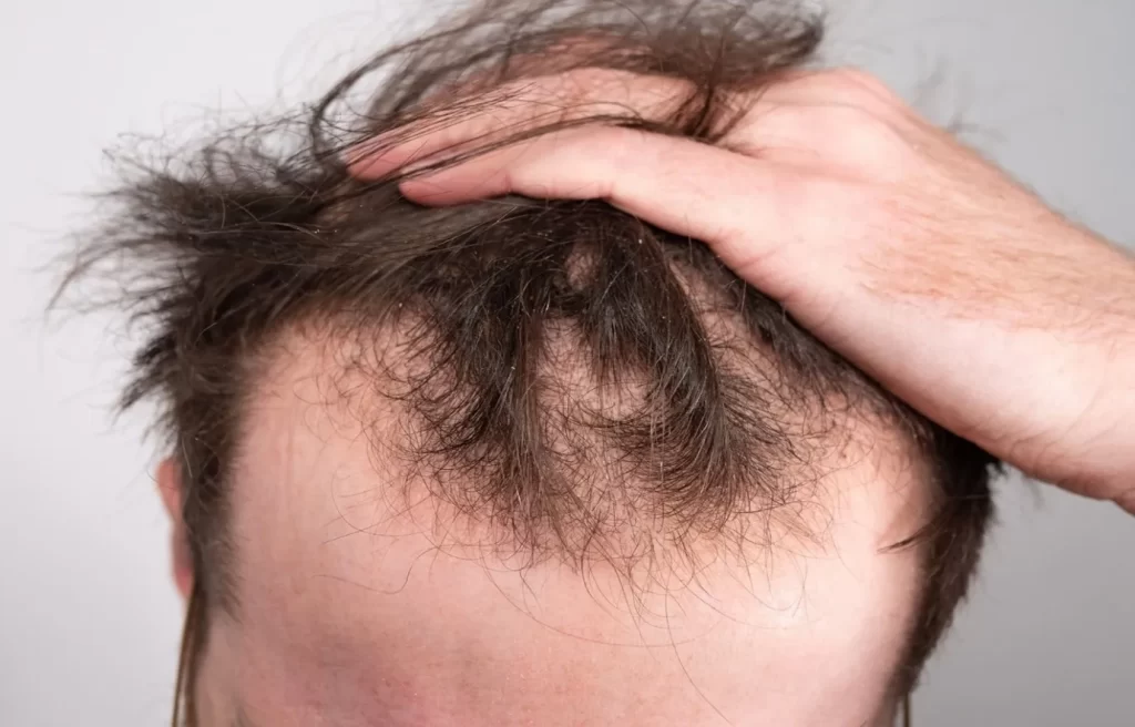 اثرات استرس در ریزش مو